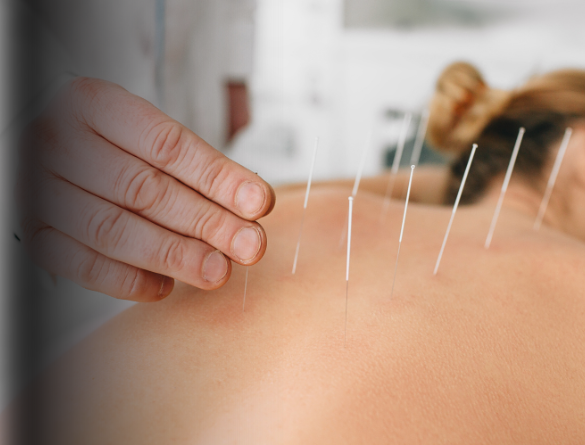 Acupuncture
